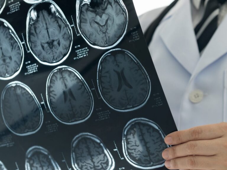 BRITANSKI NEUROLOZI: Način na koji COVID-19 napada mozak nismo nikad ranije vidjeli kod drugih virusa