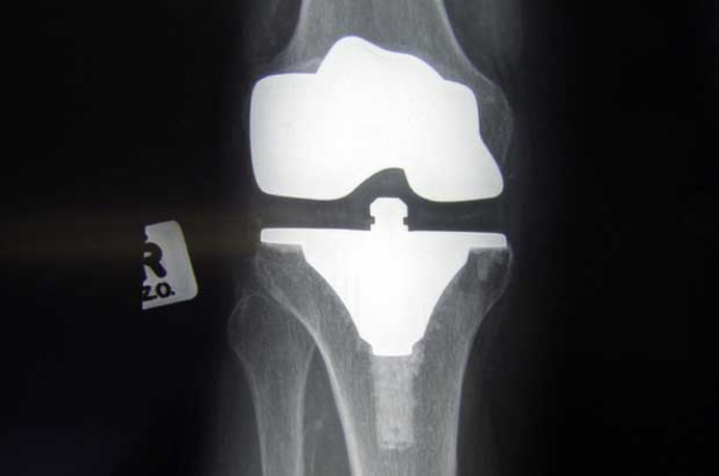 Znate li razlog zbog kojeg vam pucketaju zglobovi?