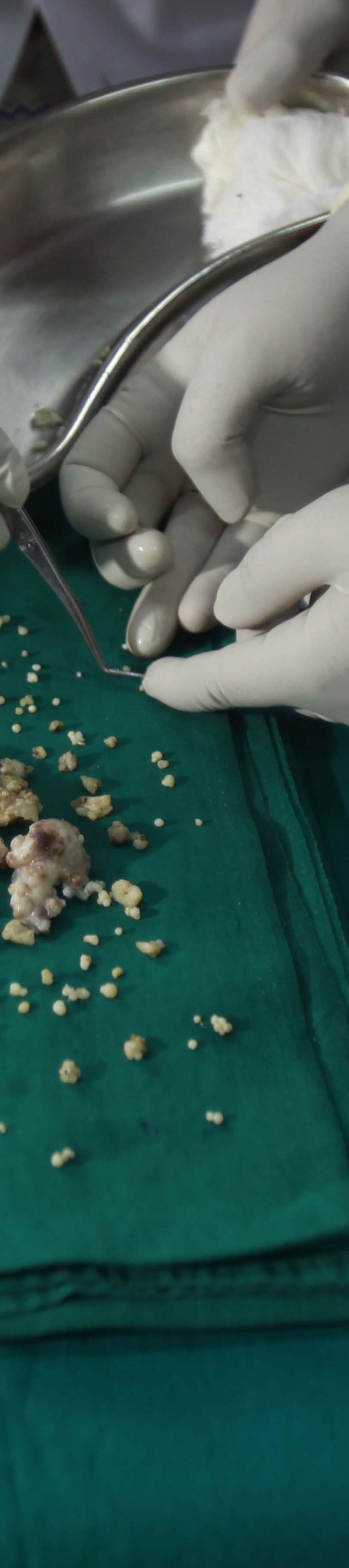 Fenomen u Indiji: Mladiću izvađena 232 zuba