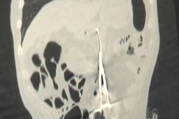 548ec884-9c88-4526-8f6c-35ceb0765237-surgeons-left-a-pair-of-scissors-inside-a-patient-after-an-operation-by-mistake11