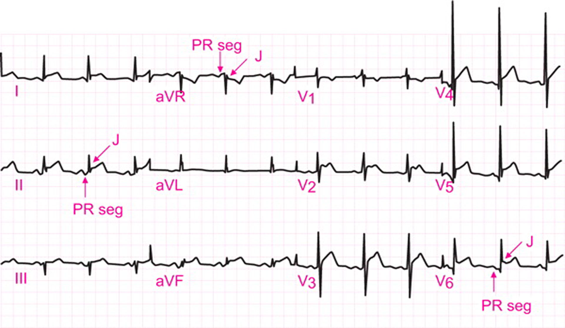 Ova bolest srca je najčešći uzrok smrti