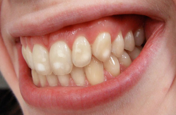 Zašto neki ljudi imaju bijele mrlje na zubima?
