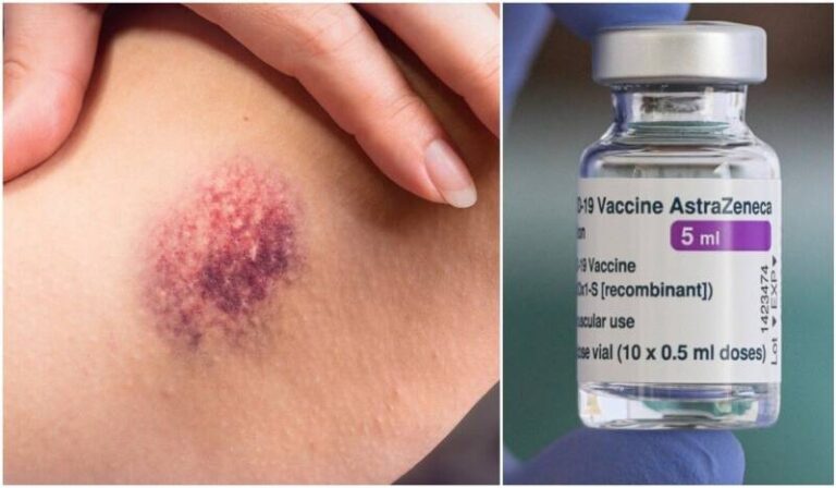 Što je trombocitopenija koju možda uzrokuje vakcina AstraZeneca?