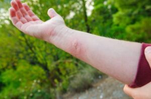 ubod strsljen pcela bol