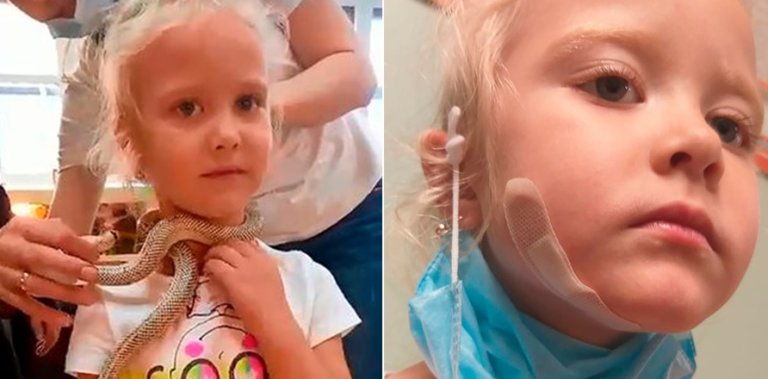 Djevojčicu u zoološkom vrtu ugrizla zmija za lice (VIDEO)