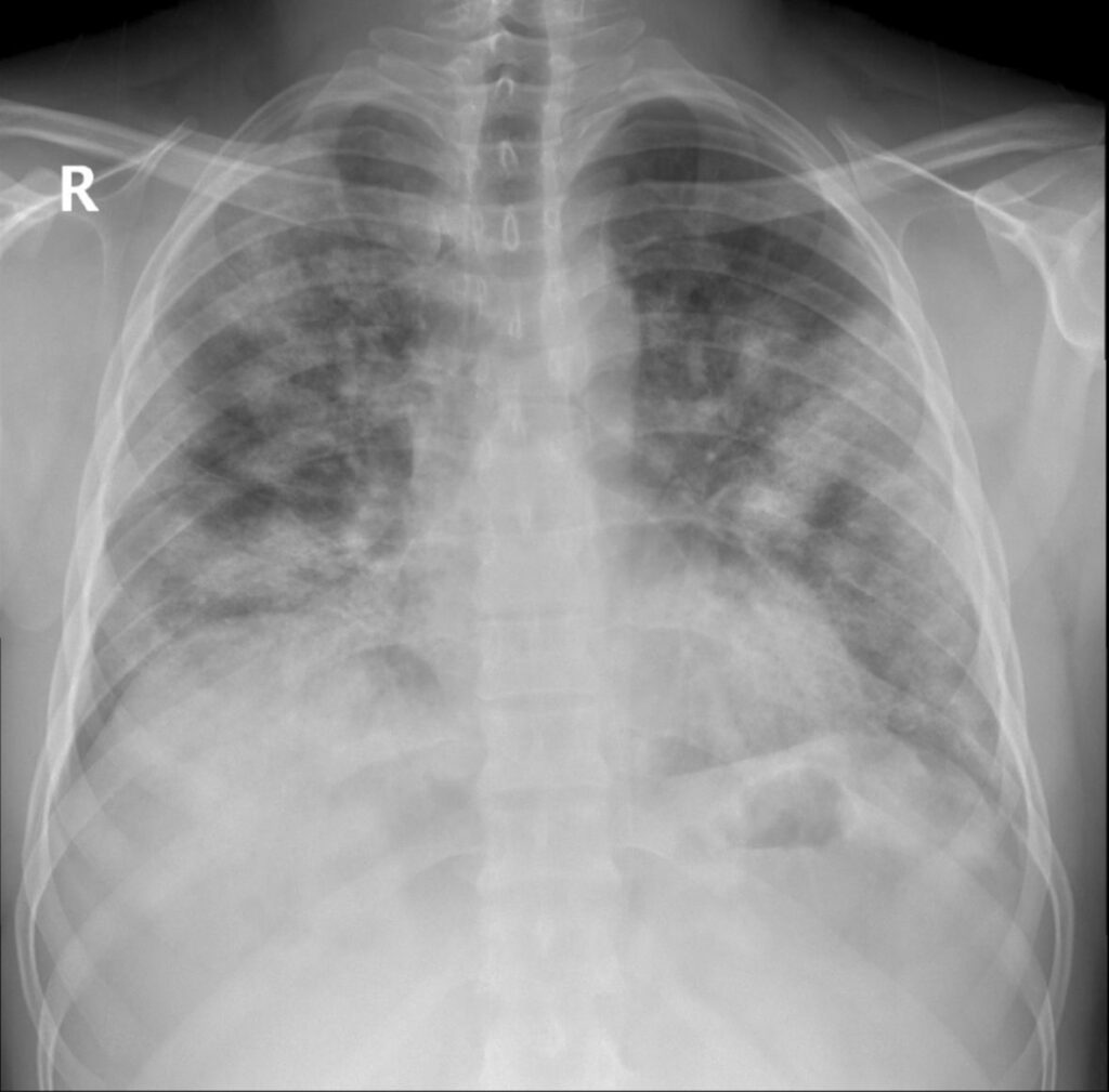 doktor turska doktorica snimak pluca nalazi covid AA20