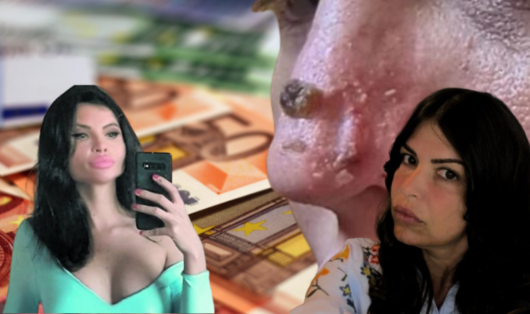 Ugrađivala hIjaluron: “Boginja lažnih usana” bi mogla dobiti tri godine zatvora