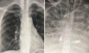 vakcinacija koronavirus 2 696x418 1