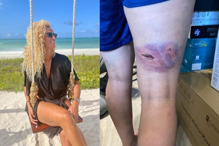 Nogometašica PSG-a opisala premlaćivanje željeznom šipkom i pokazala povrede na nozi