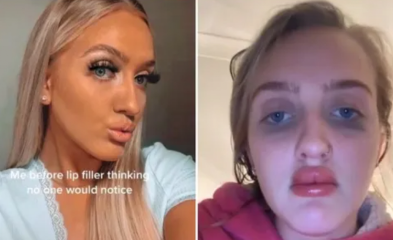 Povećanje usana pošlo po zlu: Sreća pa je korona i moraš nositi masku