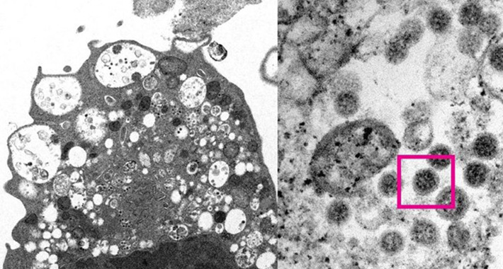Ovo su najčešći simptomi omikron soja koronavirusa