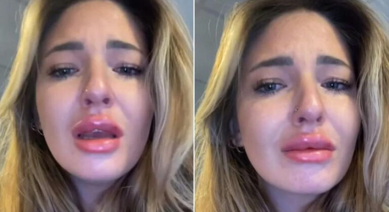 Djevojka platila više od 1000 KM za tzv. ‘ruske usne’ pa požalila: ‘Triput su veće nego što su trebale biti!’