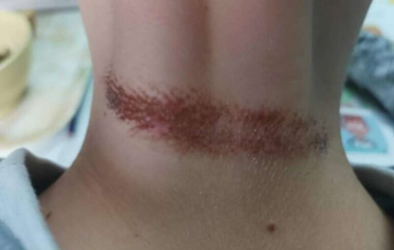 Šokantan slučaj nasilja: Osmogodišnjem dječaku stavili omču oko vrata, a zatim ga vukli