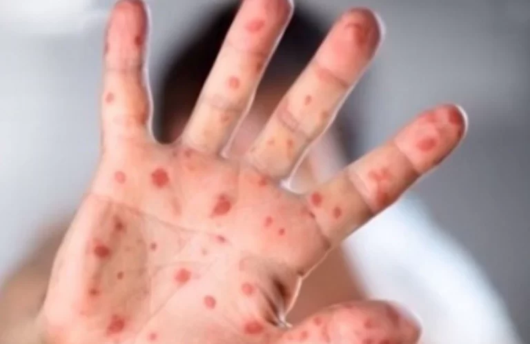 Majmunske boginje sve bliže BiH: Bolest je potvrđena kod 38-godišnjeg muškarca u…