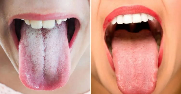 Znate li zašto jezik pobijeli? Evo kako ćete lako riješiti problem