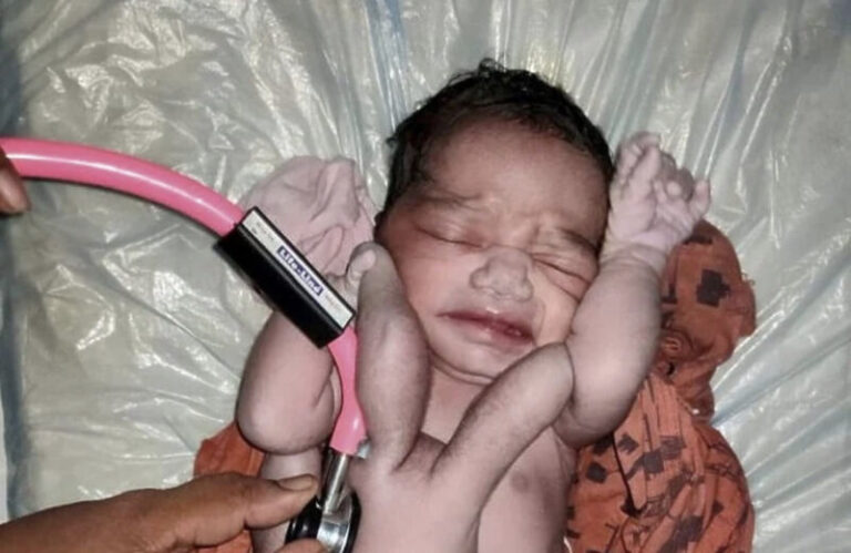 Bebu rođenu sa četiri ruke i noge proglasili reinkarnacijom Boga