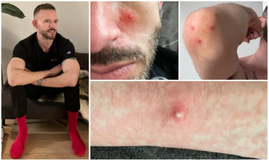 Ispovijest zaraženog: Dobio sam majmunske boginje. Plikovi su bili posvuda, vrištao sam od bolova