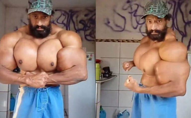 Preminuo Brazilac koji je sebi ubrizgavao ulje da bi povećao mišiće