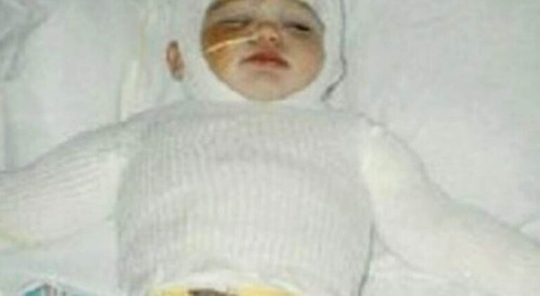 Majka stavila bebu u vrelu rernu, evo kako danas izgleda djevojčica nakon brojnih operacija