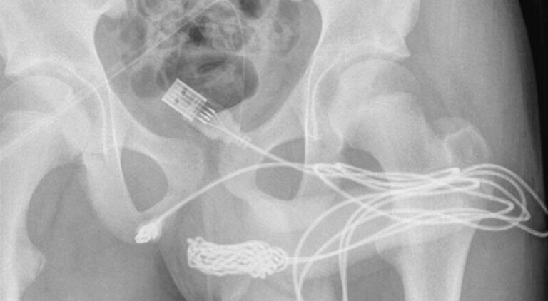 Dječak gurnuo USB kabal u polni organ