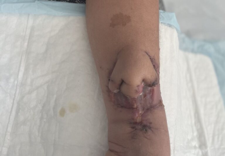 Medicinari “uzgojili” nos na ruci žene i transplantirali joj ga