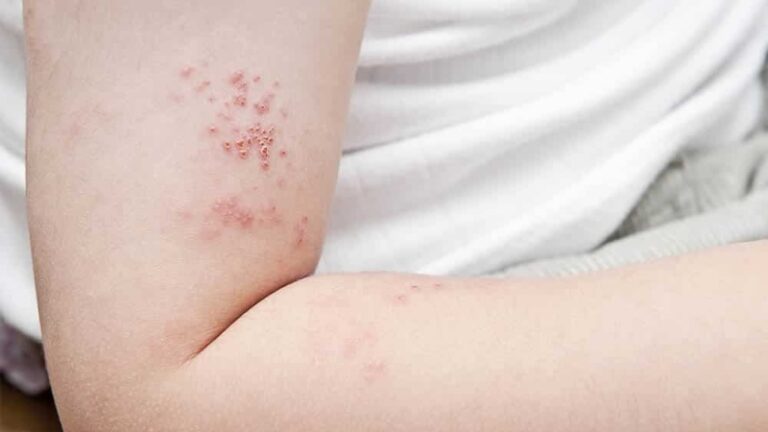 Ovaj tip zaraznog osipa može povećati rizik od infarkta za čak 30 posto