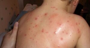 Epidemija morbila u BiH: Najkritičnije u Zenici, izdate nužne mjere