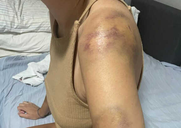 Posljedice nevremena: Grad joj napravio modrice po cijelom tijelu