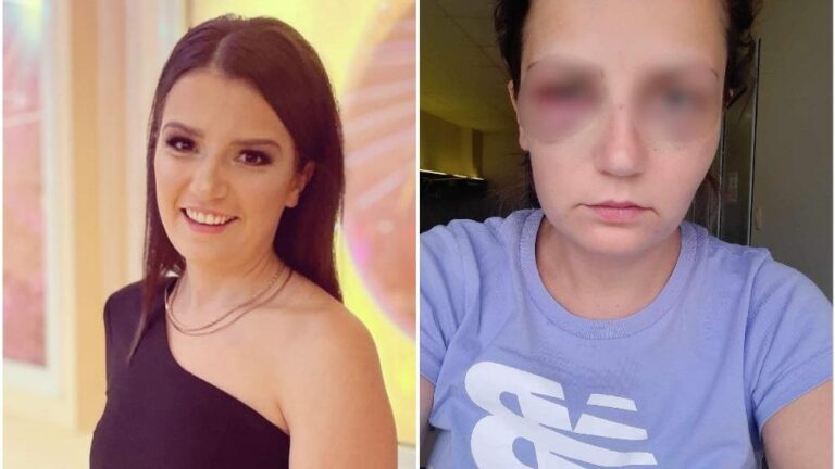 Za srijedu zakazani protesti zbog djevojke koju je pretukao vlasnik hotela