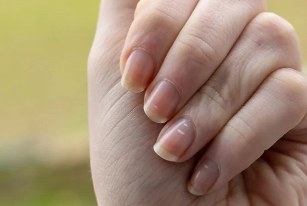 Zbog čega se na noktima pojavljuju bijele mrlje