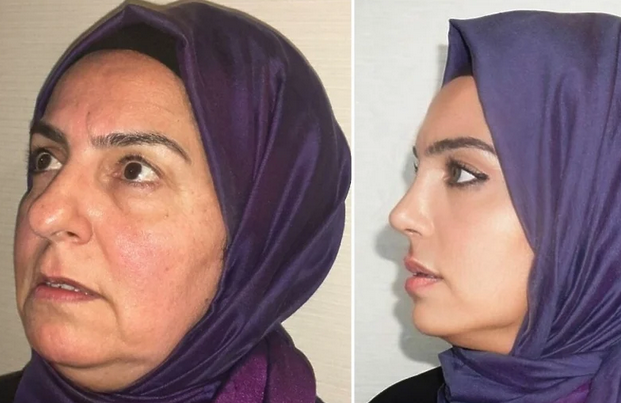 Fotografije prije i poslije plastičnih operacija šokirale ljude: Kako je ovo moguće?