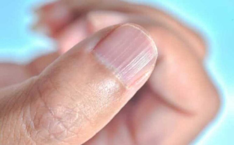 Imate vodoravne ili okomite nabore na noktima? Evo kada je vrijeme da posjetite doktora