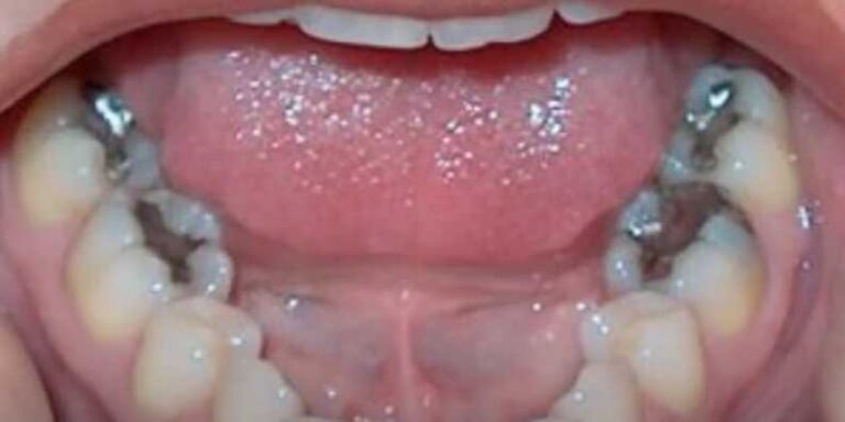 Imate crne plombe? Idite čim prije stomatologu