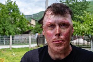 BUDIMO HUMANI: Pomozimo mladom Zeničaninu Aldinu koji je živ spaljen