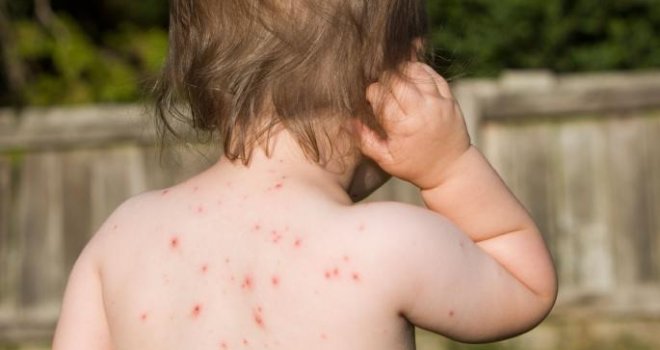 Više je od hiljadu zaraženih: ZDK će proglasiti epidemiju morbila