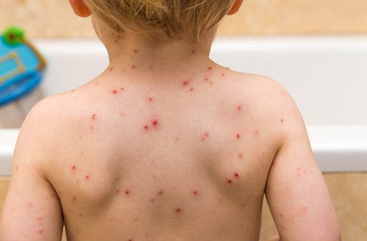 Nakon proglašenja epidemije morbila u ZDK drastično povećan broj vakcinacije djece