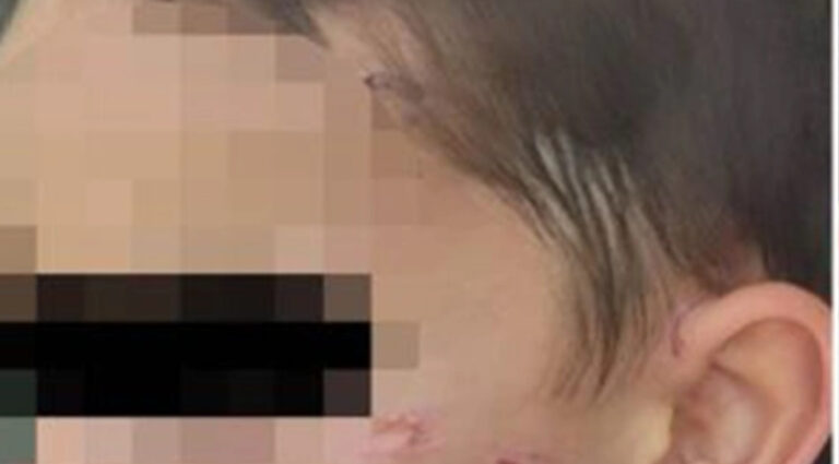 Dječak (5) optužio oca da mu je gasio cigarete po tijelu? Roditelj tvrdi da dijete laže