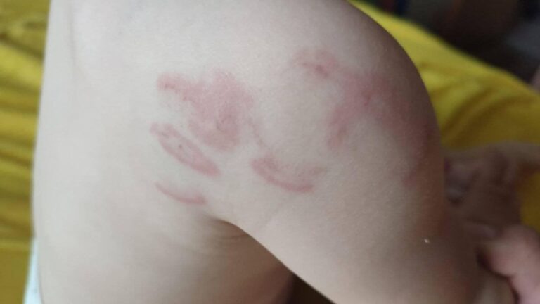Tužilaštvo KS vrši provjere u slučaju bebe koja je 14 puta izgrižena u vrtiću