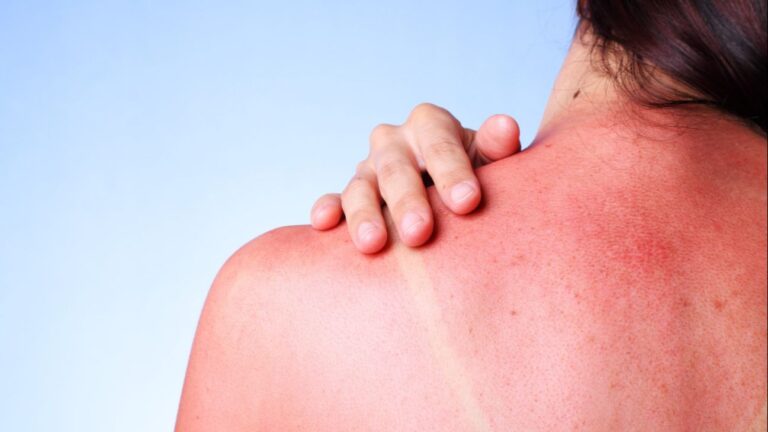 Prof. dr. Reuf Karabeg: Pretjerano izlaganje suncu može dovesti do razvitka melanoma