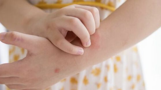 Prema posljednjim podacima Zavoda za javno zdravstvo FBiH: Sve više i slučajeva šuge