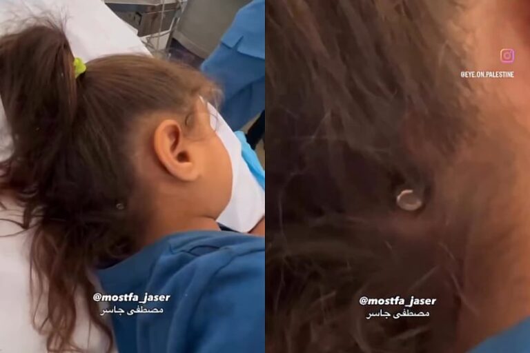 Čudo među hiljadama ubijenih: Djevojčica iz Gaze preživjela direktni pogodak metkom u glavu