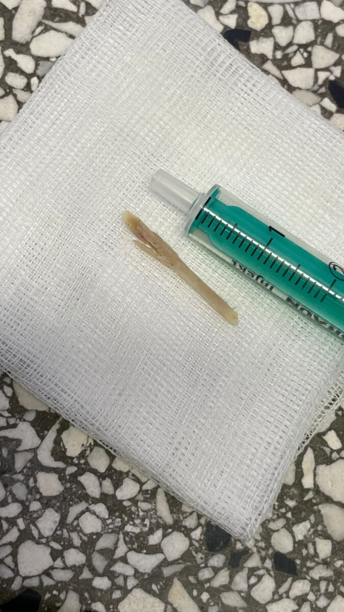 U Zagrebu djevojčici u vrtiću zapela kost u grlu, rekli roditeljima da “samo traži pažnju”