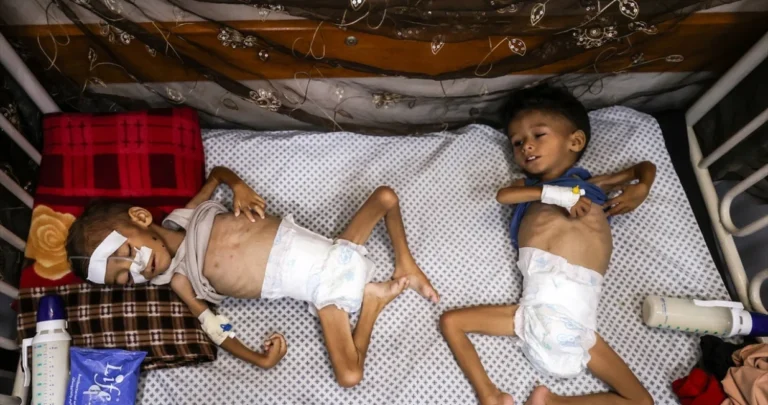 (FOTO) Potresne slike djece suočene s glađu u Gazi: Braća se bore za život zbog pothranjenosti