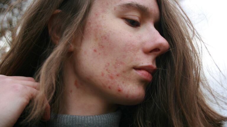 Bubuljice kao alarm: Šta lice govori o vašem zdravlju