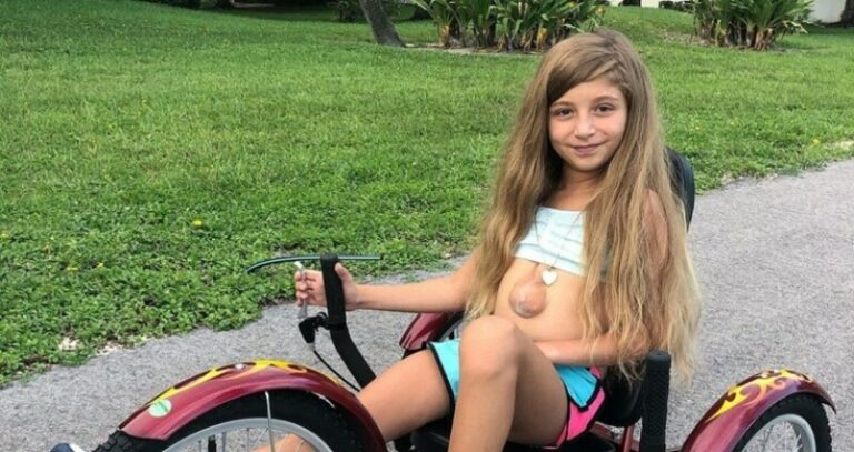 Djevojčica živi sa srcem izvan grudnog koša