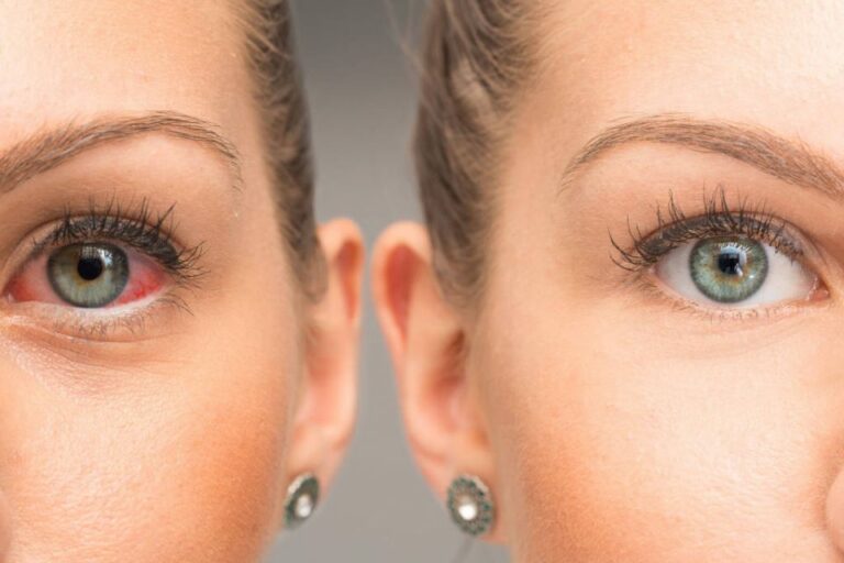 Dr. Dervišević: Crveno oko može biti znak zaraze Corona virusom