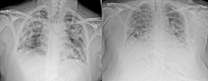 SNIMCI POKAZUJU STETU KOJU KORONAVIRUS IZAZIVA NA PLUCIMA aa 1 696x271 1