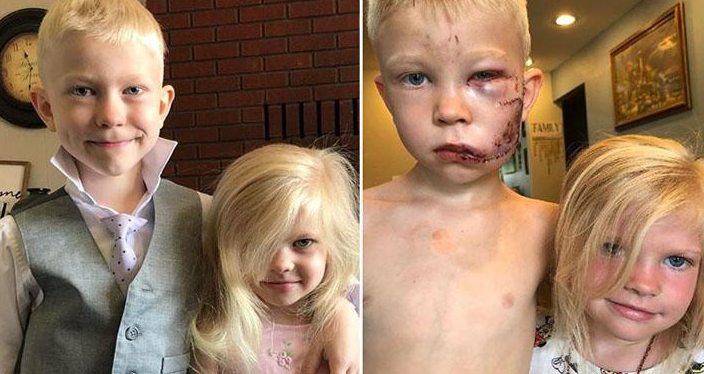 Mali heroj! Šestogodišnjak spasio sestricu od pobješnjelog psa i rekao: Ako je neko trebao umrijeti, mislio sam da to trebam biti ja