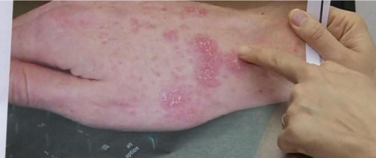 Šuga napada i u 21. stoljeću!