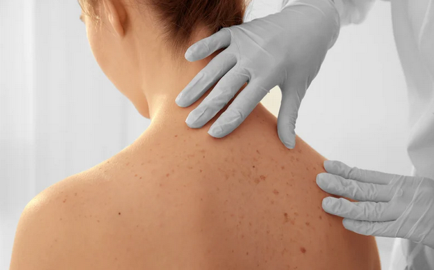 Ne čekajte na pregled mladeža: Prevencija je najubojitije oružje u borbi protiv melanoma